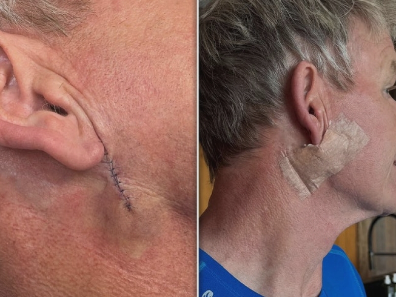 gordon ramsay gets treatment to remove skin cancer shows surgery scar 68b325ad18e3a