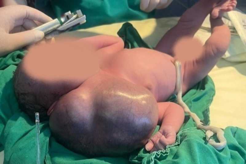cluj tumora gigant operata cu succes la un nou nascut la spitalul de copii 68d67a7025bce