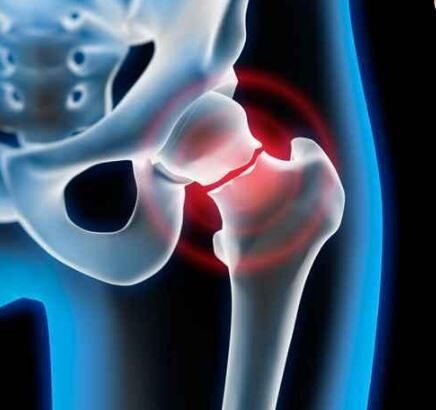 20 octombrie ziua mondiala a osteoporozei 68f5df18e6bed