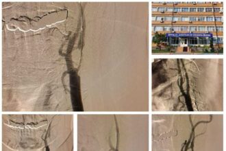 buzau interventii in premiera la spitalul judetean buzau angioplastia carotidiana si angioplastia subclavie 6926db3d5a10f
