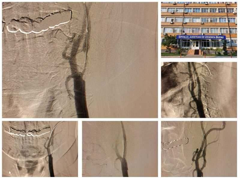 buzau interventii in premiera la spitalul judetean buzau angioplastia carotidiana si angioplastia subclavie 6926db3d5a10f