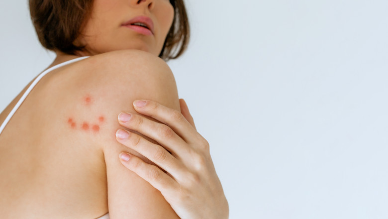 cum recunosti muscatura de plosnita medicii explica riscurile pentru sanatate poate declansa reactii alergice puternice 6933c8185ab08